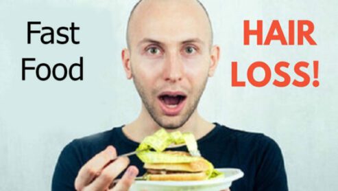 Fast Food Hair Loss